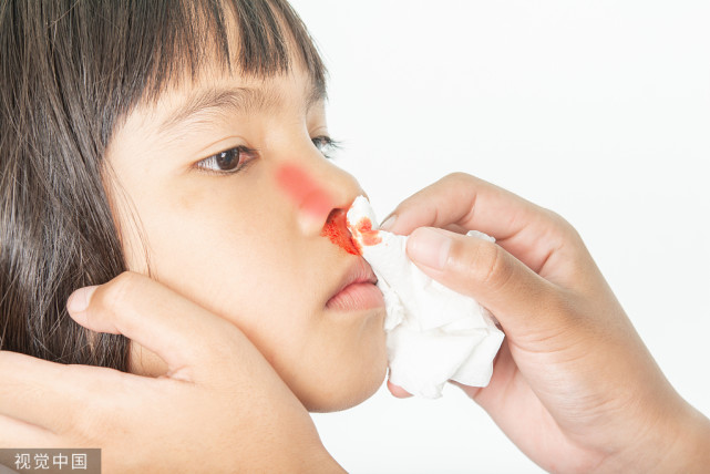 孩子流鼻血千万别仰头止血塞纸巾正确止血3步法家长要牢记