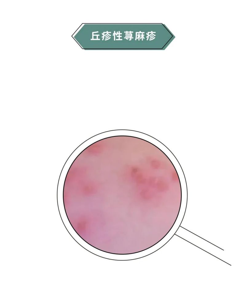 一到夏天背上就长小疙瘩千万别抠