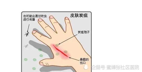 山西省文水县发生疑似皮肤炭疽疫情,9人出现炭疽病相似症状