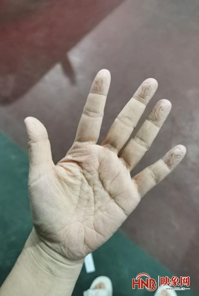 【河南"金牌"抗疫人】深深的勒痕,浸渍发白的双手 彰显了责任与担当