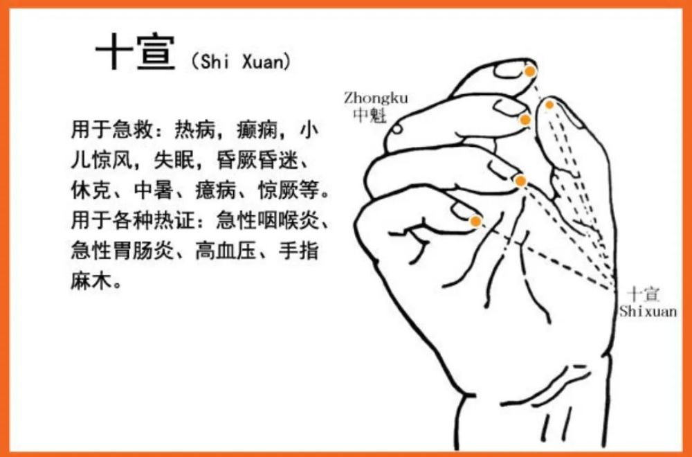 该疗法出自《千金要方》,主治一切急性病之失神吐泻,扁桃体炎,高血压