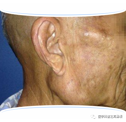 腮腺腫瘤作者簡介parotid gland tumor得了腮腺腫瘤怎麼辦