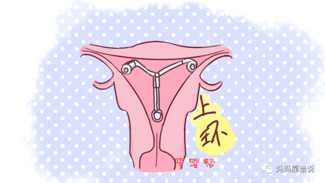 上节育环的女性,若身体出现这些现象,要尽快取环