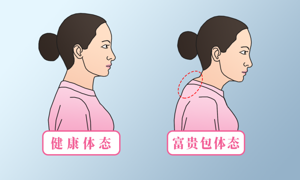 颈椎长富贵包说明你要保养了