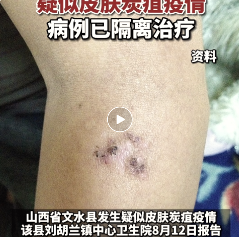 山西省文水县刘胡兰镇中心卫生院报告,发现疑似皮肤炭疽疫情