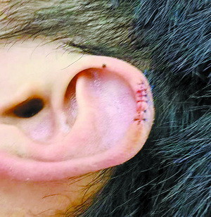 近日,市民林先生致电本报热线968820反映这一情况,他的耳朵受伤后缝了