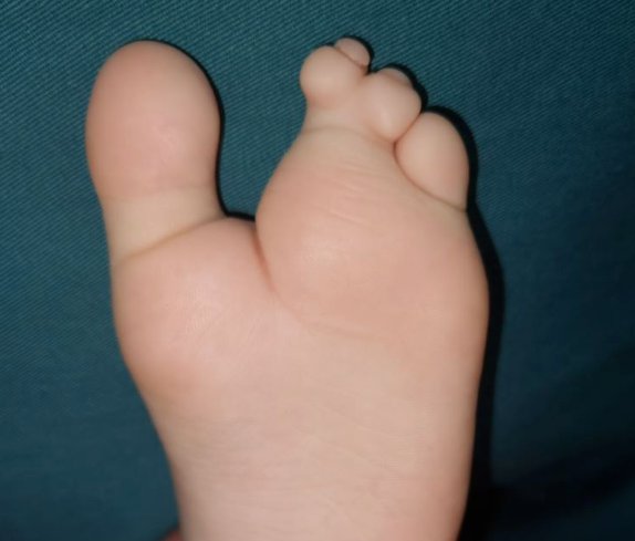 孩子并趾伴裂足,需要做几次手术?