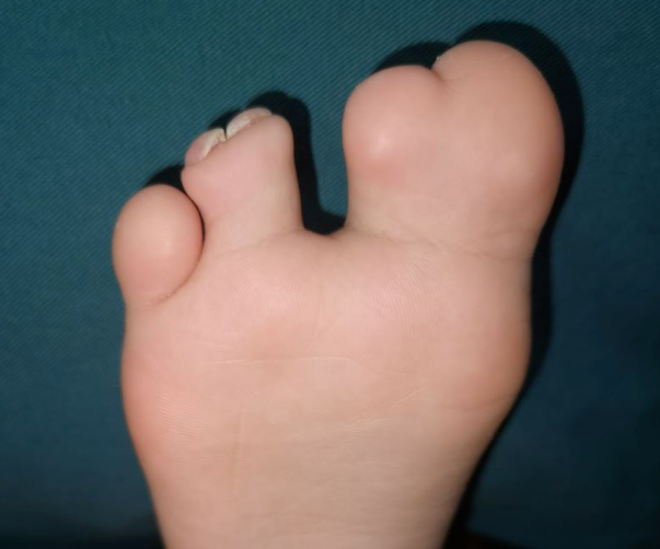 孩子并趾伴裂足,需要做几次手术?