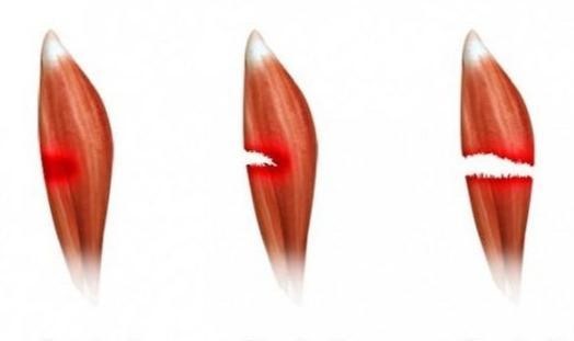 除了疼痛,肌肉拉伤的症状还包括肌肉痉挛或紧张,局部肿胀或皮下出血