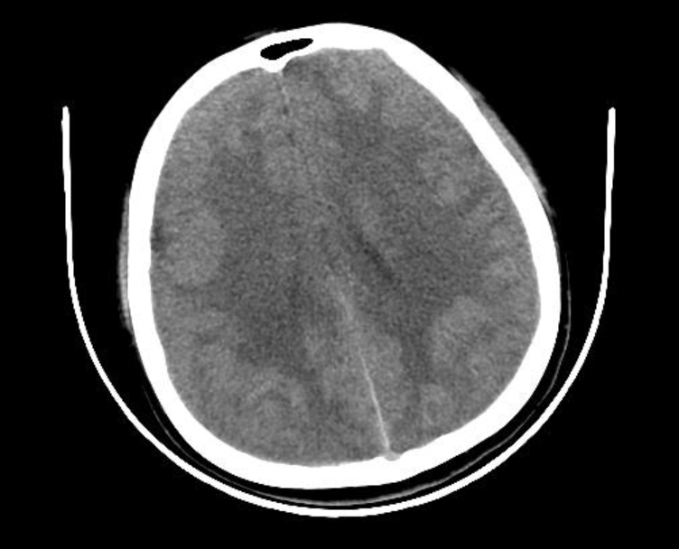 一例脑膜炎奈瑟菌血流感染患者的诊疗全程及引发的思考
