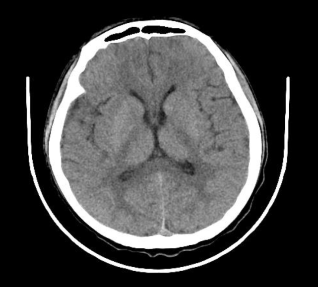 一例脑膜炎奈瑟菌血流感染患者的诊疗全程及引发的思考