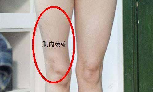 截瘫患者最容易肌肉萎缩,要怎样缓解肌肉萎缩?