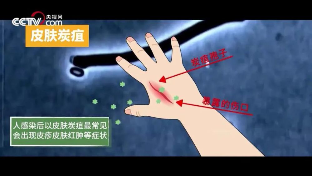 警惕山西文水县发生疑似皮肤炭疽疫情9人出现症状尚未发现人传人