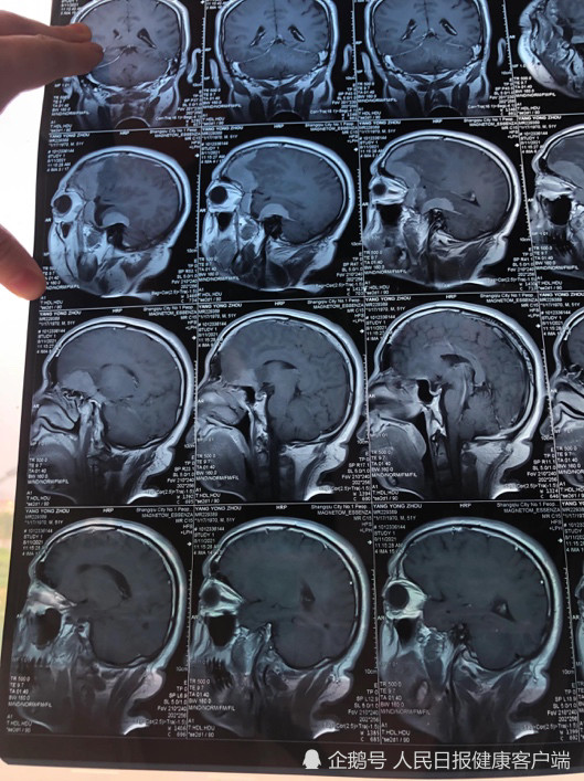 求助:商丘隔离人员复发脑膜瘤病情严重,多方积极协调解决