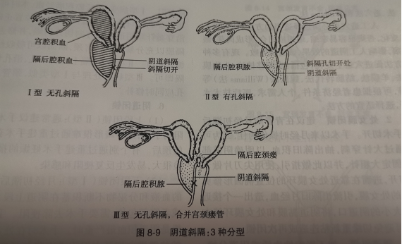 以雙子宮,雙宮頸,雙陰道和一側陰道完全或不完全閉鎖的先天性畸形,多