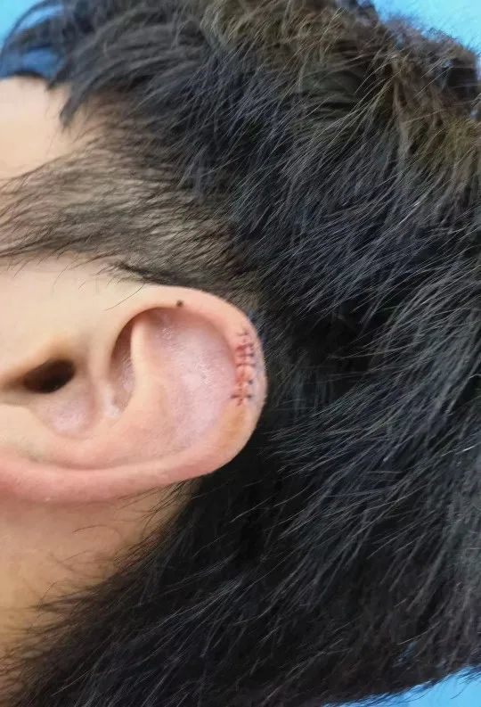看着都疼厦门一小伙理发时耳朵被剪伤缝了6针