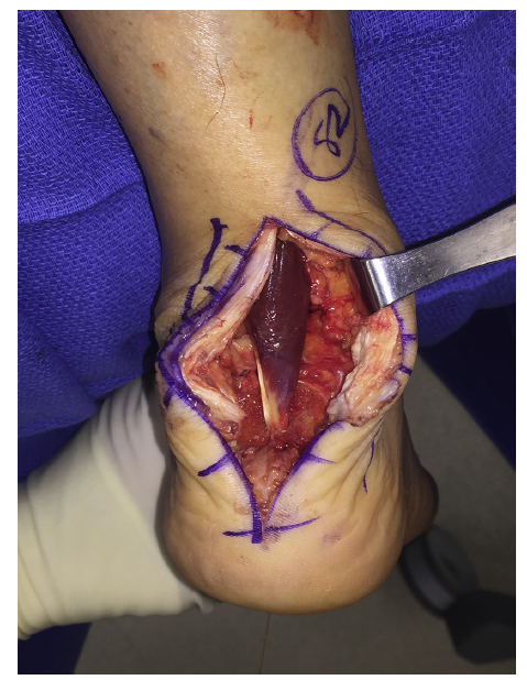 骨科精讀腳後跟反覆疼痛haglund綜合徵要引起注意