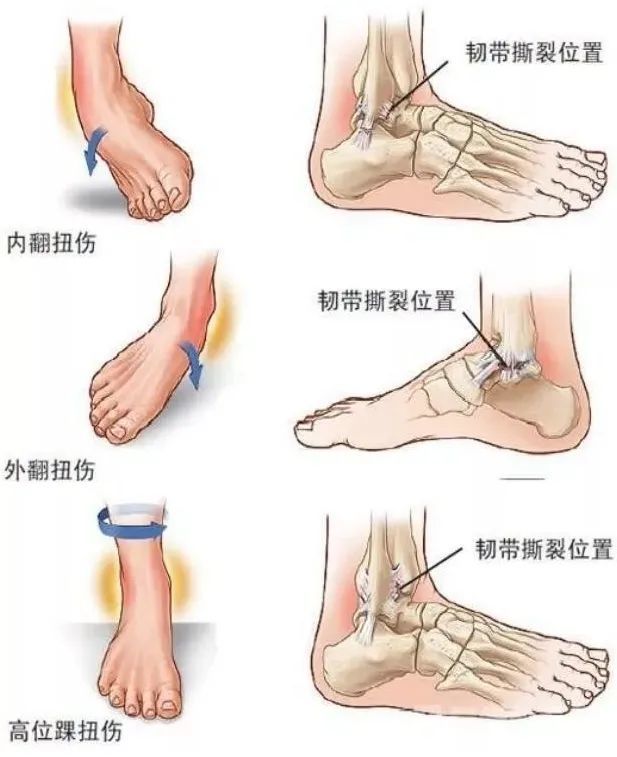 崴脚了怎么办快速消肿（崴脚了怎么办）-第2张图片-潮百科