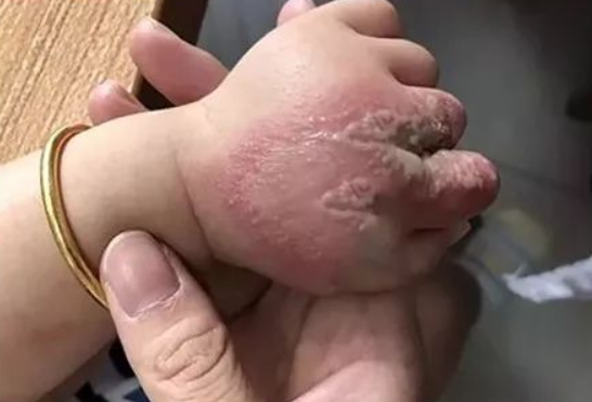 妈妈拍虫子,宝宝皮肤溃烂险毁容!这种虫子不叮人却比眼镜蛇还毒