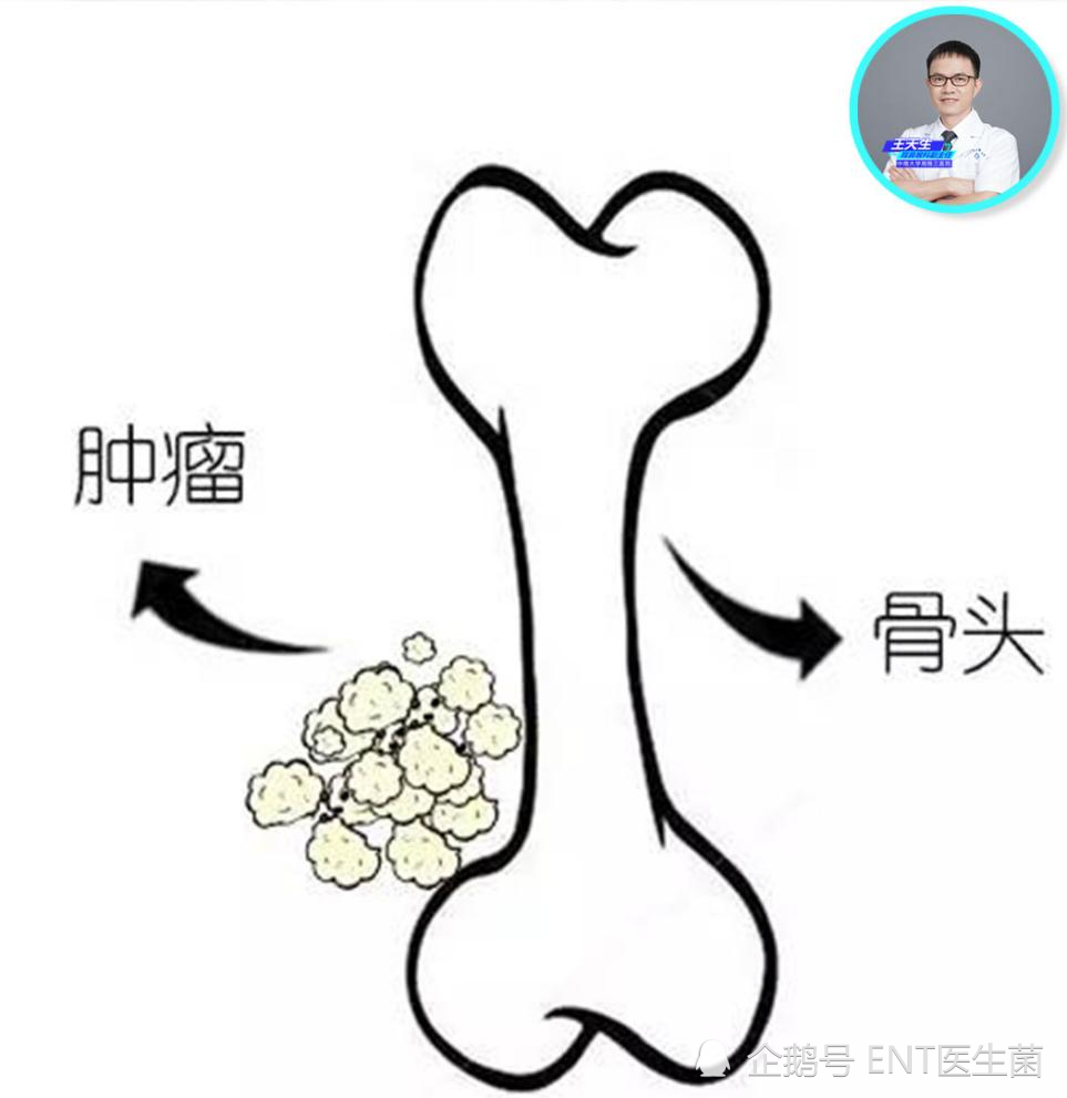 骨肿瘤能活多久图片