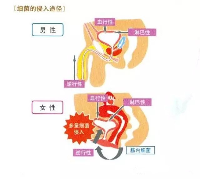 膀胱癌