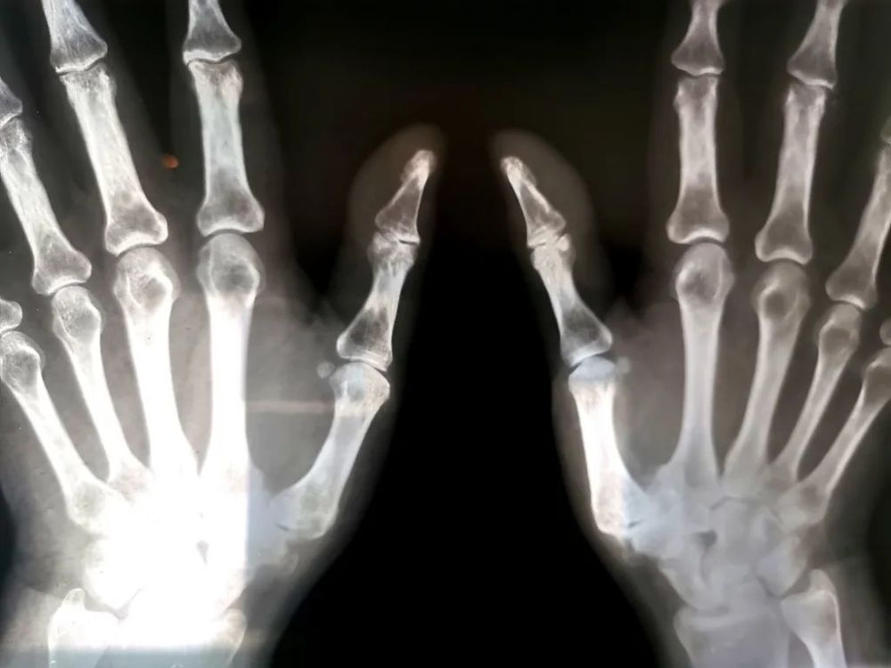 可怕it程序员手酸疼7年一查发现骨头已融成了豆腐渣