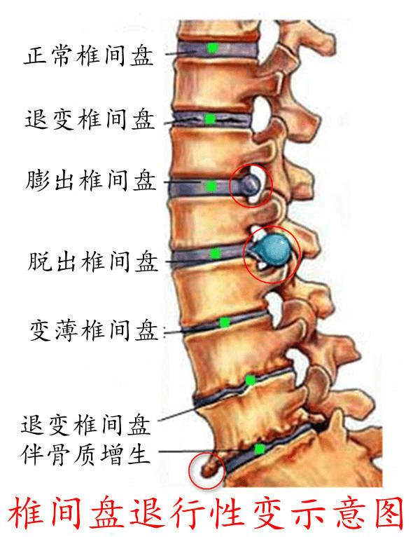 l5/s1椎间盘位置图图片