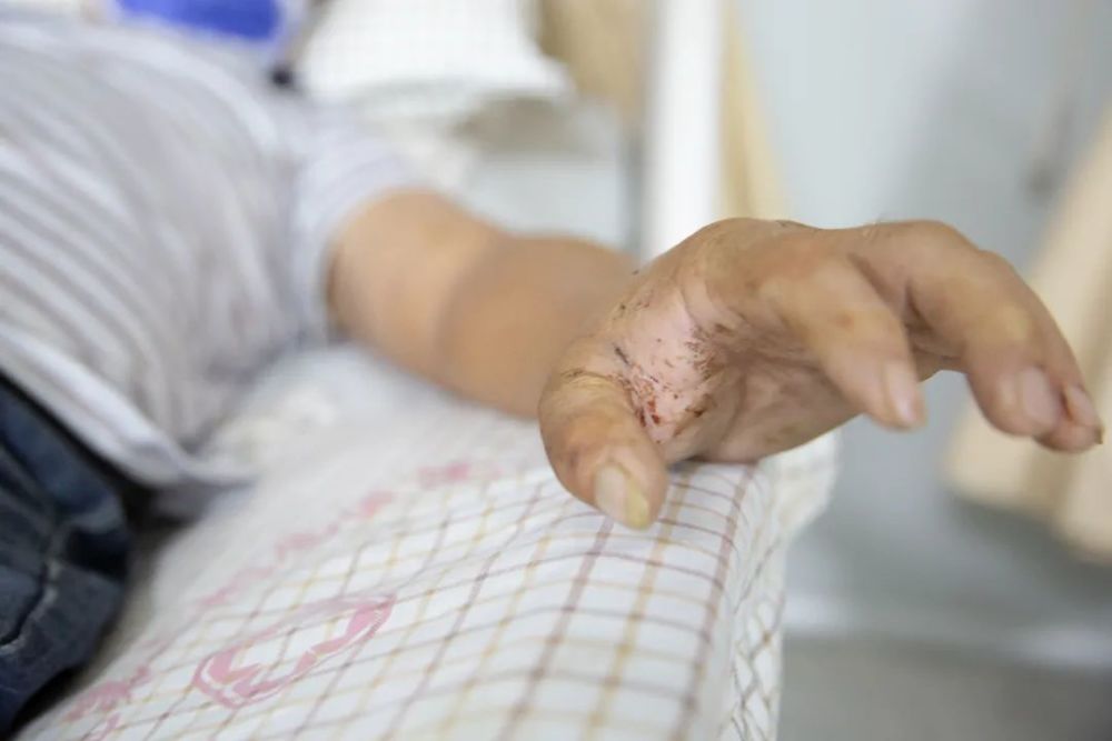 惊险桂林一男子被眼镜王蛇咬伤却不当回事命差点没了