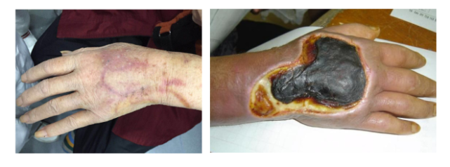 图片说明:化疗药物致静脉炎和药物外渗但当中心静脉导管在留置期间