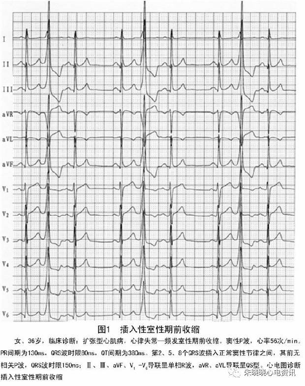 室上性期前收缩心电图图片