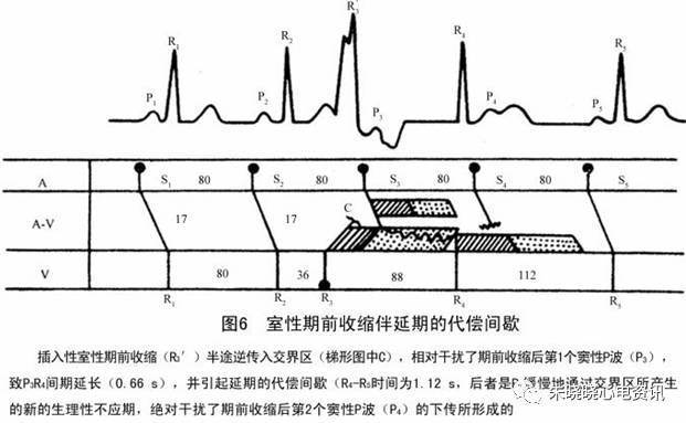 卢喜烈教授心电系列之二十四:图解室性期前收缩的代偿间歇