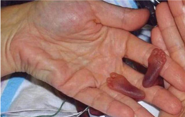 世界上最小的婴儿图片图片