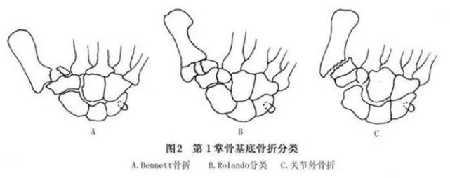 骨科|關節|固定|關節內骨折|掌骨骨折|克氏針