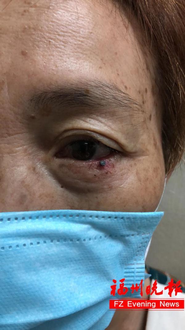 女子眼皮现"血泡",10天不消,还会动!竟然是