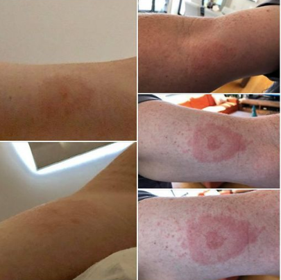 人被蚂蚁咬伤差点丢命这份毒虫咬伤急救手册你最好看一下