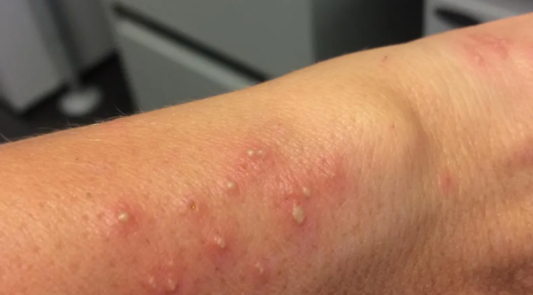 人被蚂蚁咬伤差点丢命这份毒虫咬伤急救手册你最好看一下