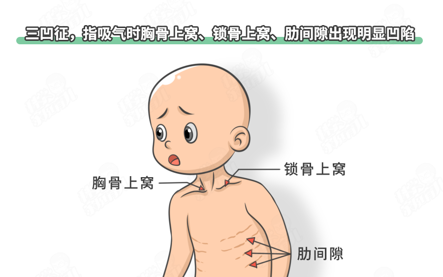 咳嗽似狗叫 3大典型症状,有1个就危险_腾讯新闻