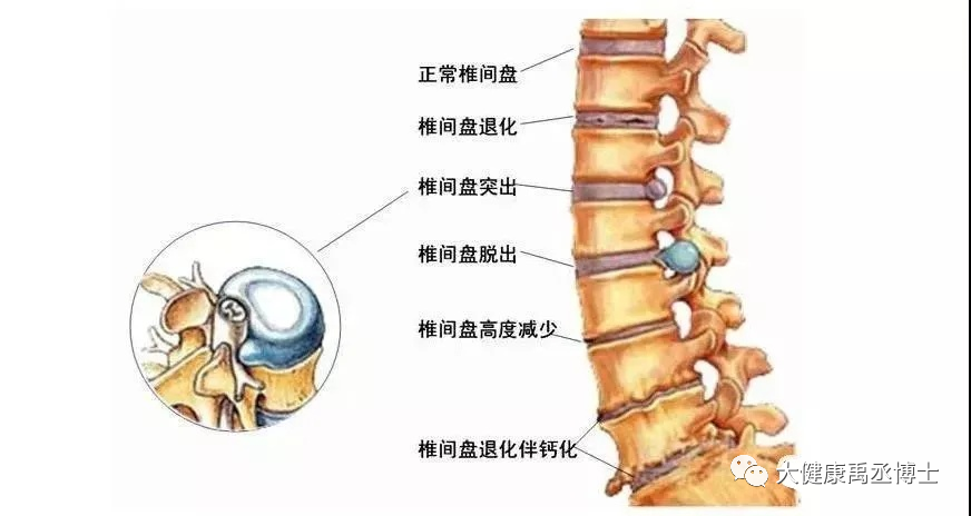 拯救你的老腰幹細胞治療腰椎間盤突出疼痛效果顯著