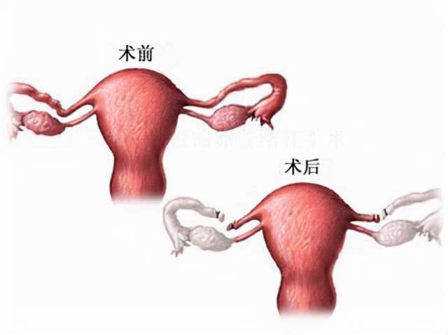 女性做了结扎手术后,还能再次怀孕吗?