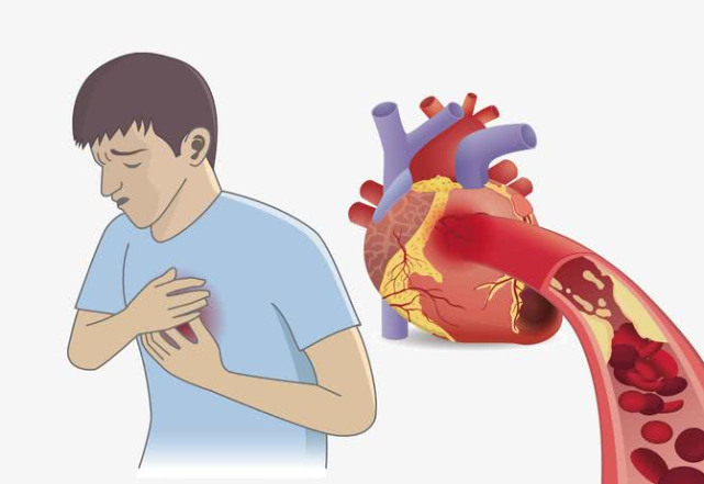 安贞医院汇总10年数据发现:年轻"心梗"患者里,95%是男性