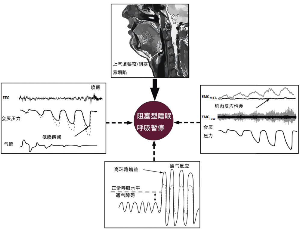 目前主要将该病理状态分为两型:阻塞型睡眠呼吸暂停与中枢型睡眠呼吸