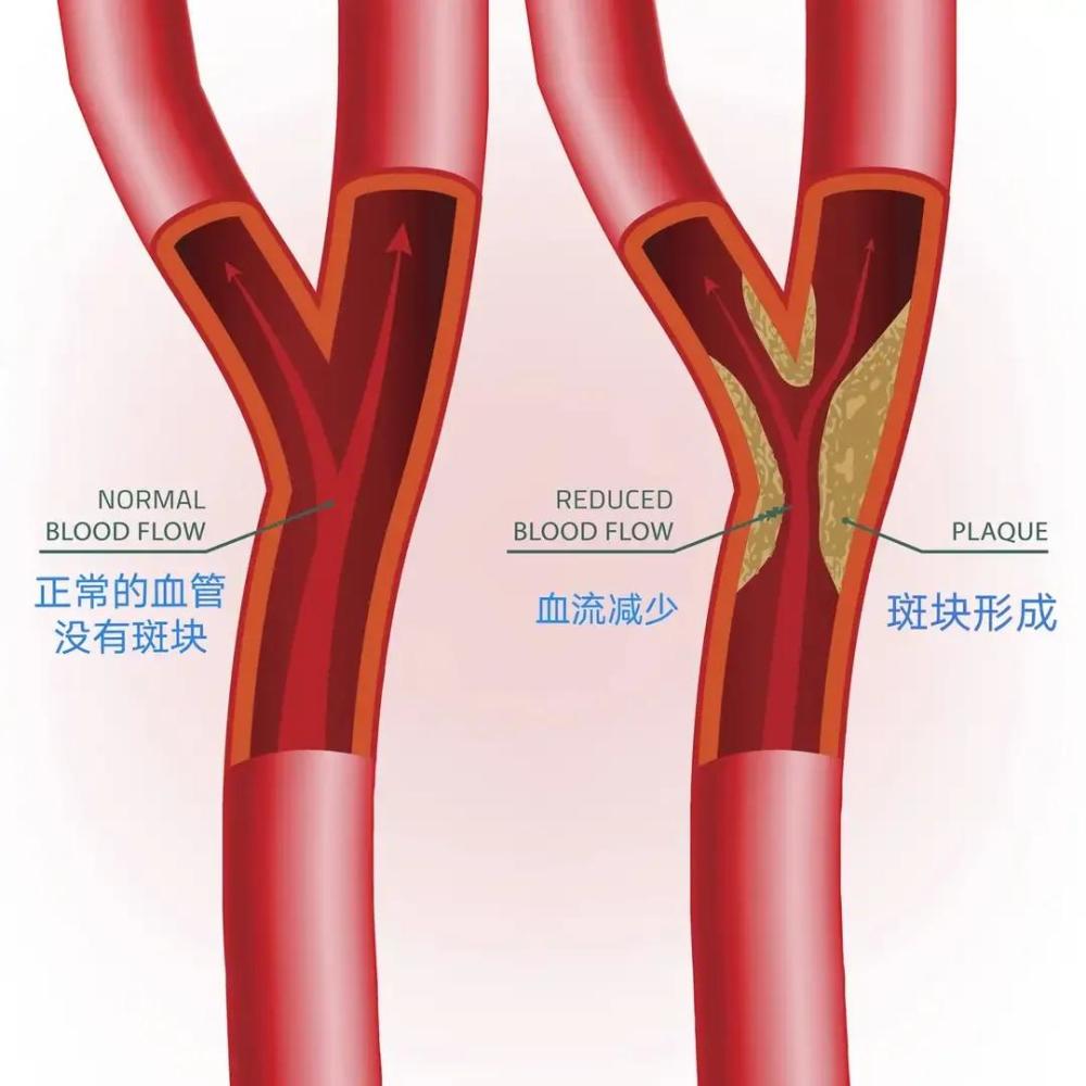 儿童颈动脉小鼓包图片