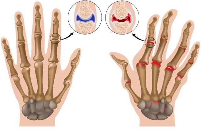 手指肿痛僵硬有结节预示着哪些疾病医生详述常见的6种病因