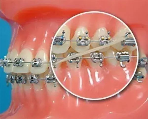 牙齿矫正挂橡皮筋的作用是什么要戴多久只在晚上戴可以不