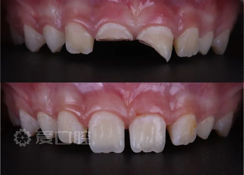 1121冠折后自体牙再粘结修复1例