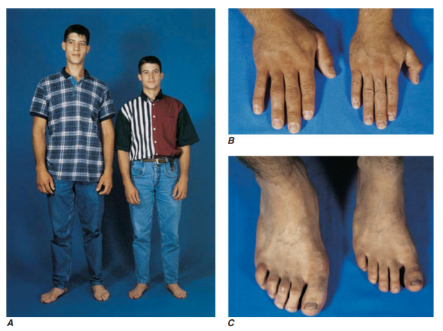 治好了我多年未愈的"大手大脚"|垂体瘤|内分泌科|肢端肥大症|生长激素