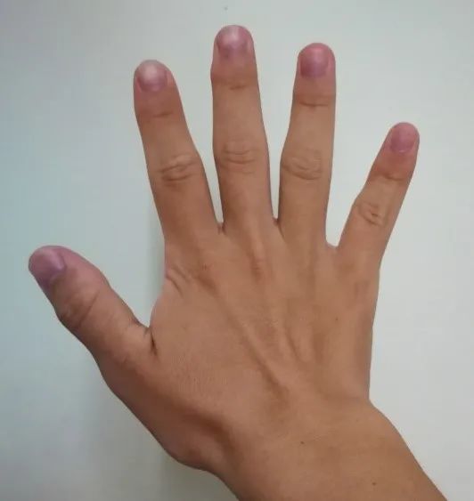 两个红色的,向上的箭头赫然映入眼中,我知道肢端肥大症基本可以确诊了