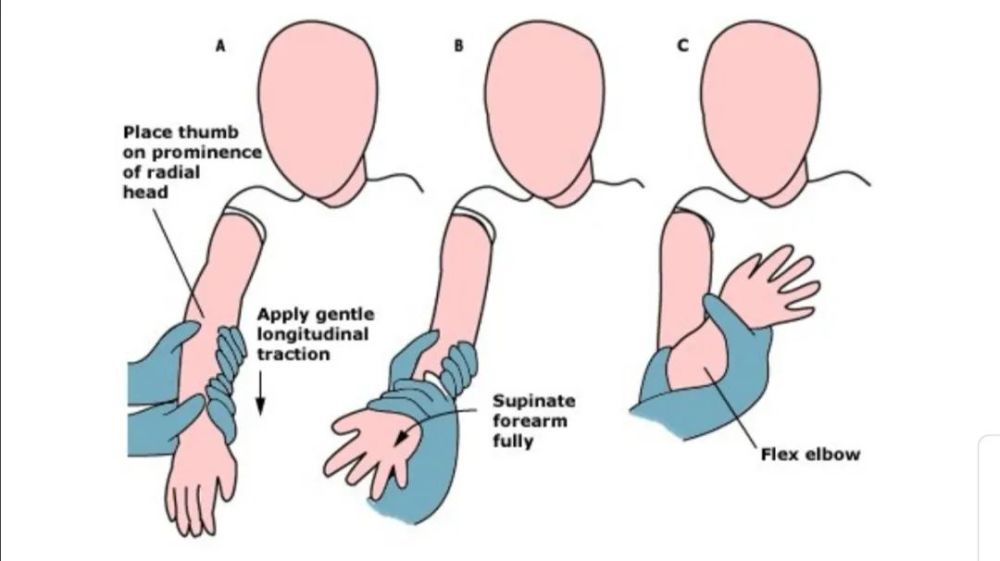 【骨科小技巧】兒童橈骨頭半脫位(rhs)的復位!_騰訊新聞