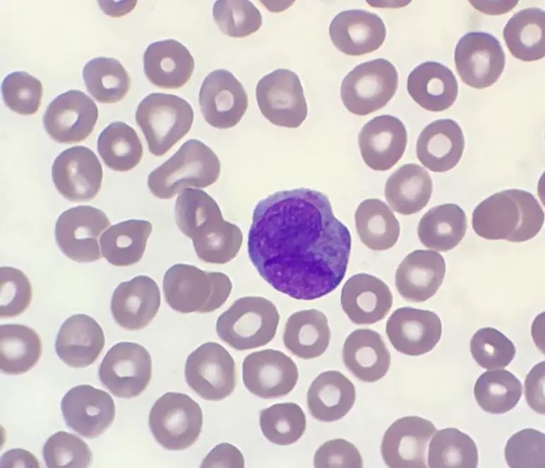 图12 肺片型的早幼粒细胞(2)关于早期识别m3的要点中,有老师提及血