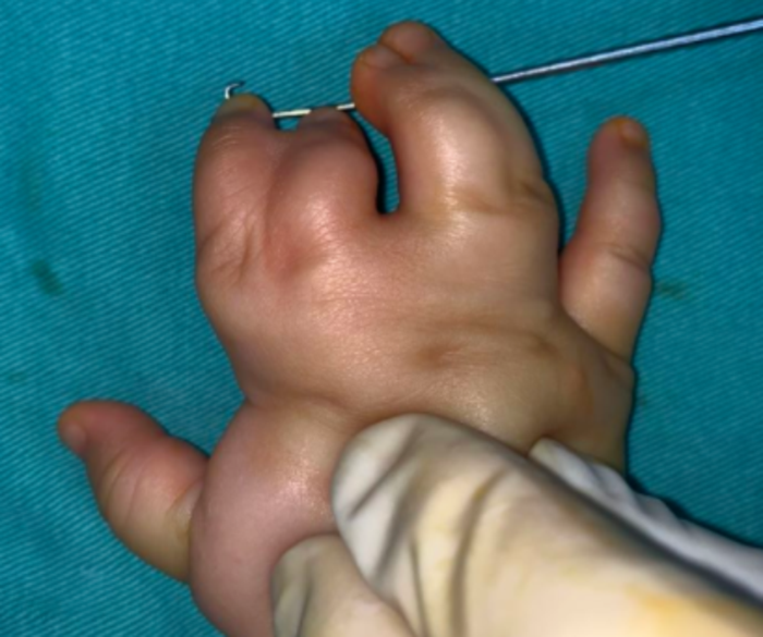 并指伴多指,术后孩子的手指外形和功能很不错